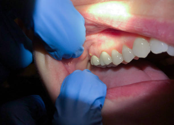 Best Broken or Cracked Tooth Emergency Dentist in Fredericksburg, PA